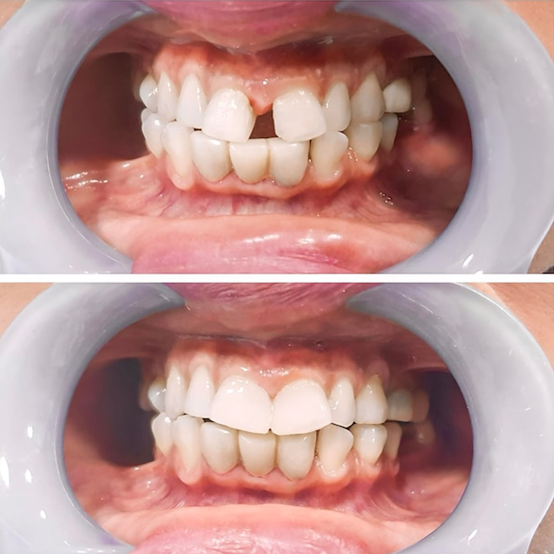 Before and after of Dental Implants